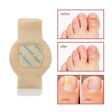Generic Fungal Nail Patches (Yellow)